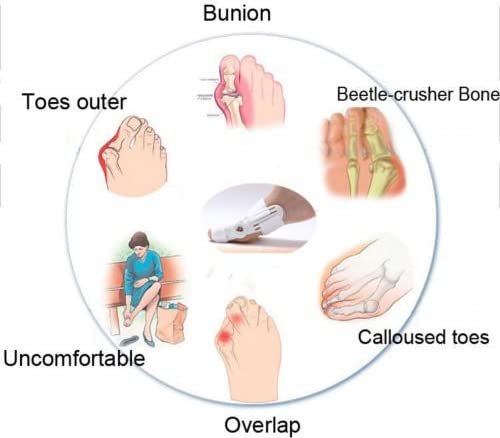 Correcteur & Orthèse de Pied – Soutien et Confort pour Hallux Valgus - الصورة 7